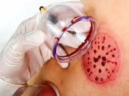 2 مرکز حجامت و زالو درمانی غیرمجاز در فیروزه تعطیل شد ۲ مرکز حجامت و زالو درمانی غیرمجاز در فیروزه تعطیل شد