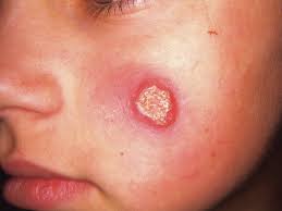 بیماری سالــک بیماری سالــک