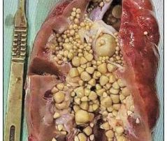 نقش تغذیه در بیماران دچار سنگ کلیه اگزالاتی نقش تغذیه در بیماران دچار سنگ کلیه اگزالاتی