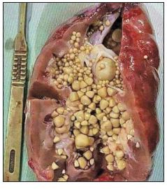 نقش تغذیه در بیماران دچار سنگ کلیه اگزالاتی نقش تغذیه در بیماران دچار سنگ کلیه اگزالاتی